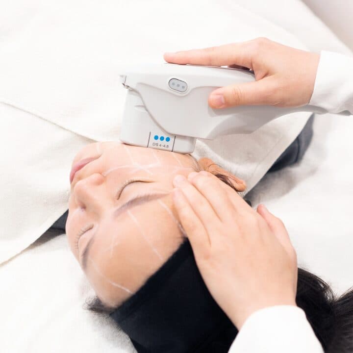 HIFU / Ultherapy (Non-Surgical Lift)