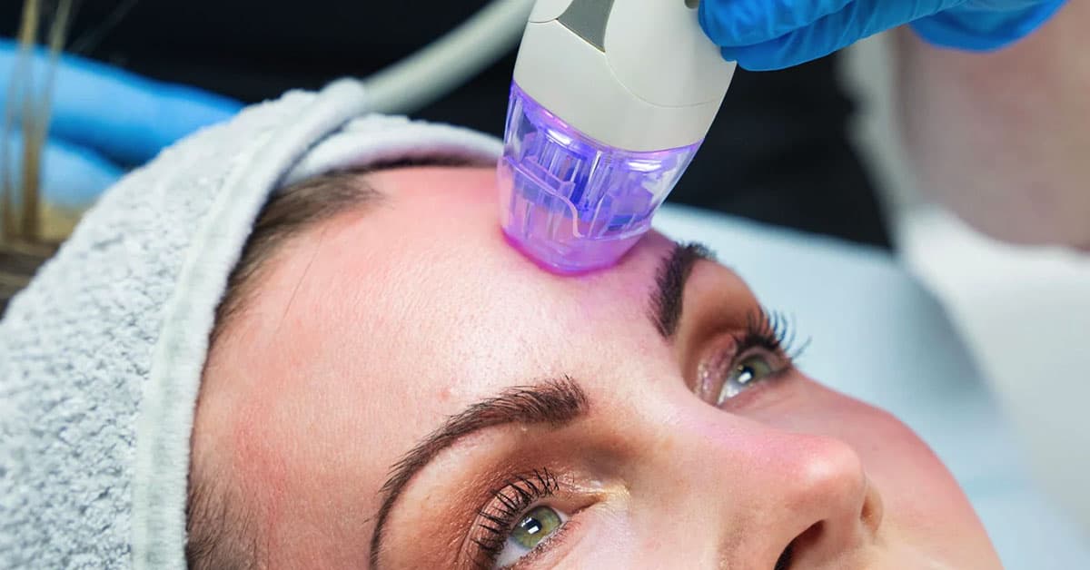 Professional Microneedling (RF Microneedling)