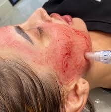 PRP Facial (Vampire Facial)
